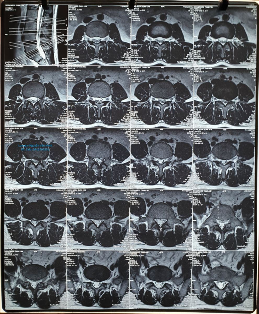 Thoát vị đĩa đệm lưng